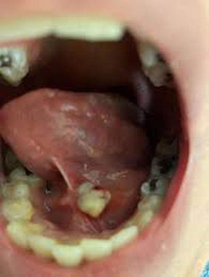 Symptoms of sialolithiasis