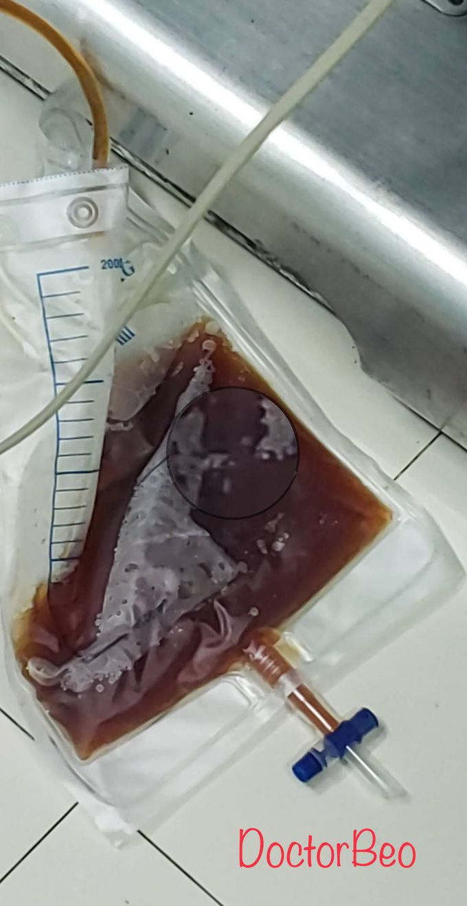 Urine of a case have severe preeclampsia with HELLP syndrome