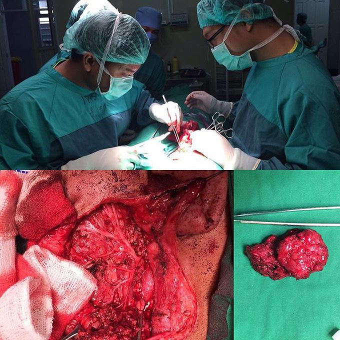 Superficial parotidectomy with meticulous facial nerve preservation 