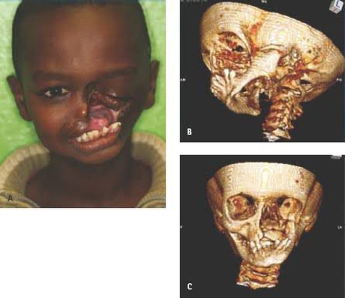 Noma disease treatment