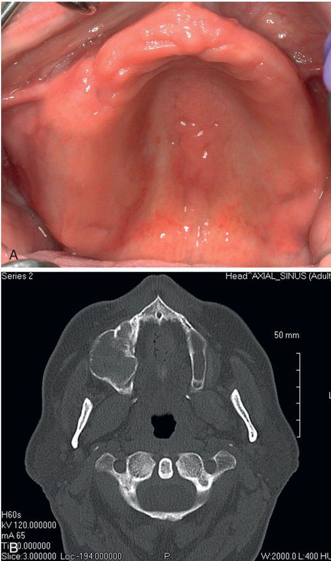 Ossifying Fibroma.