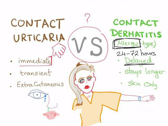 Difference between Contact Dermatitis and Contact Utricaria