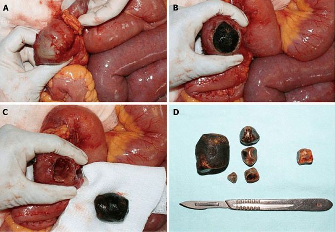 Gallstone extracted from the bowel!