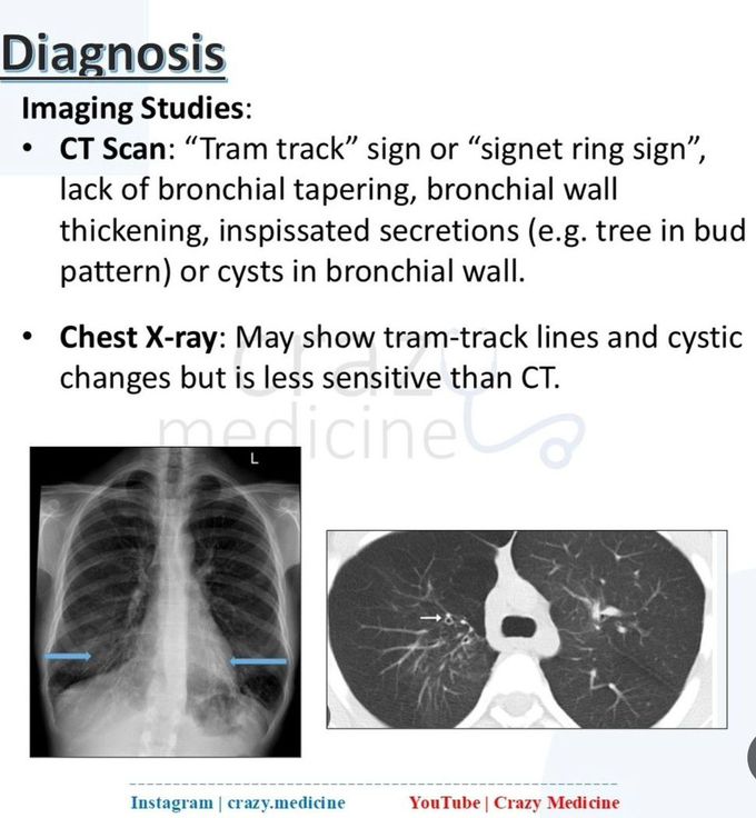 Bronchiectasis VII