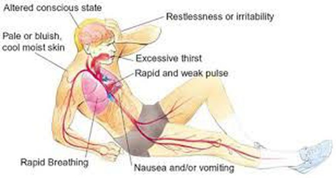 Symptoms of hypovolemic shock