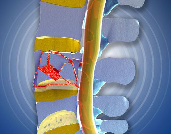 Burst fracture