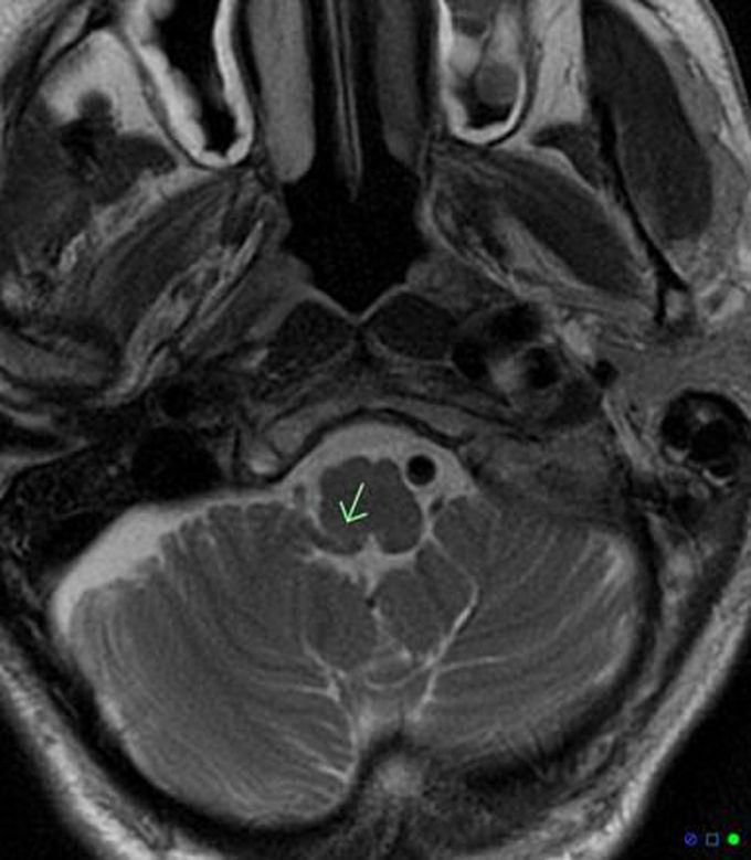 lateral pontine syndrome mri