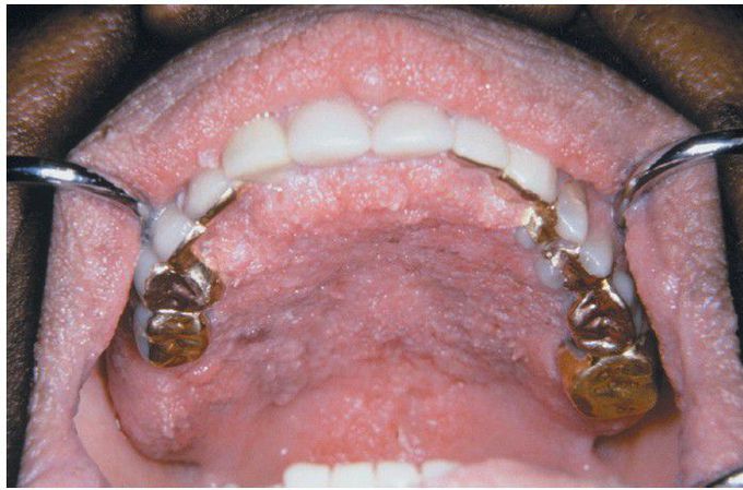 Acanthosis Nigricans.