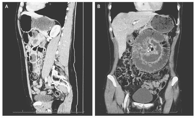 Mechanical Small-Bowel Obstruction