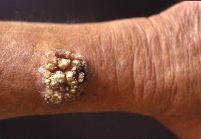 Can wart cause cancer ?