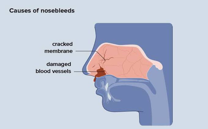 These are the causes of nosebleeds