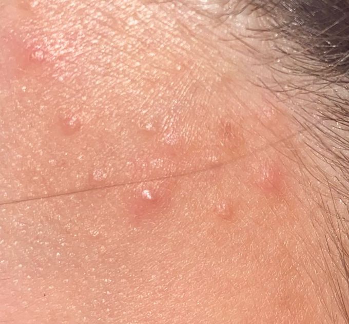 Pimples