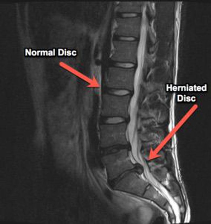 MRI showed herniated disc