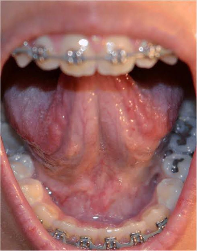 Lingual frenulum