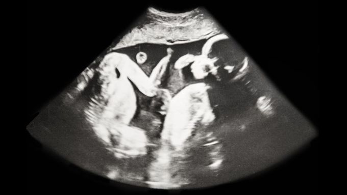 Doctors Identify Rare Pair of Semi-Identical Twins in Australia