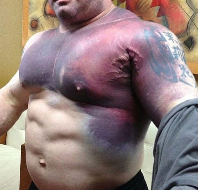 Pectoralis major tear