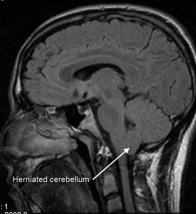 Arnold Chiari malformation