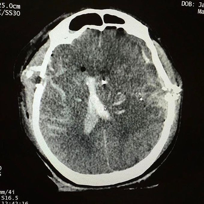 CT Scan of self inflicted gunshot wound to the head with the entrance and exit wounds clearly visible!