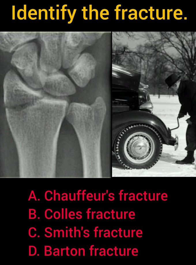 Identify the Fracture