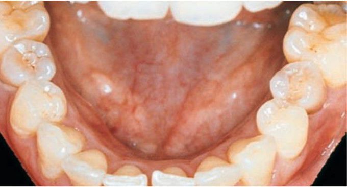Dens evaginatus of mandibular 2nd premolars