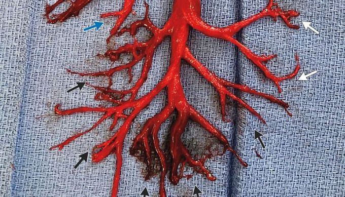 Giant Blood Clot