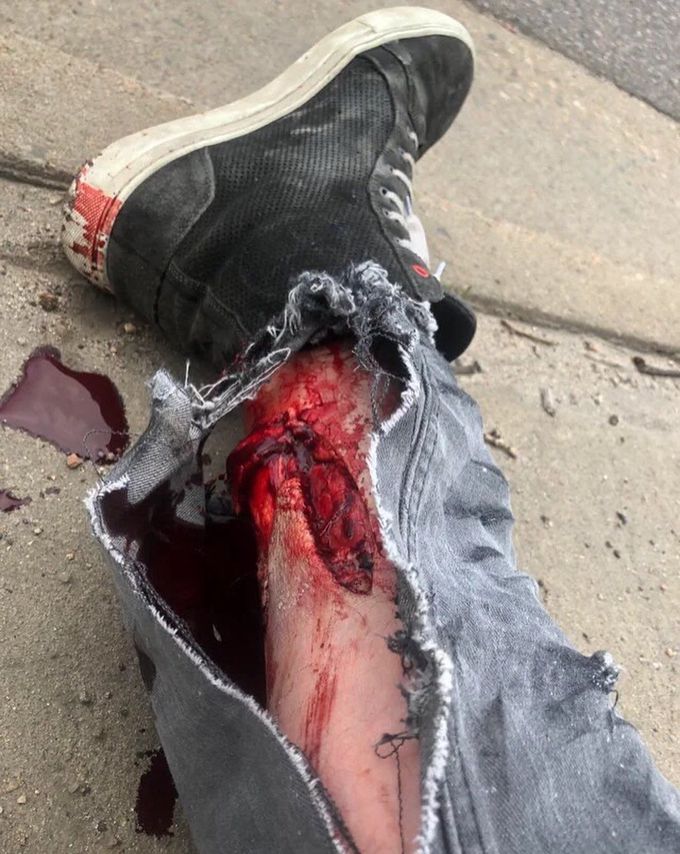 Gruesome motorcycle accident after a footpeg went through the man's calf muscle.