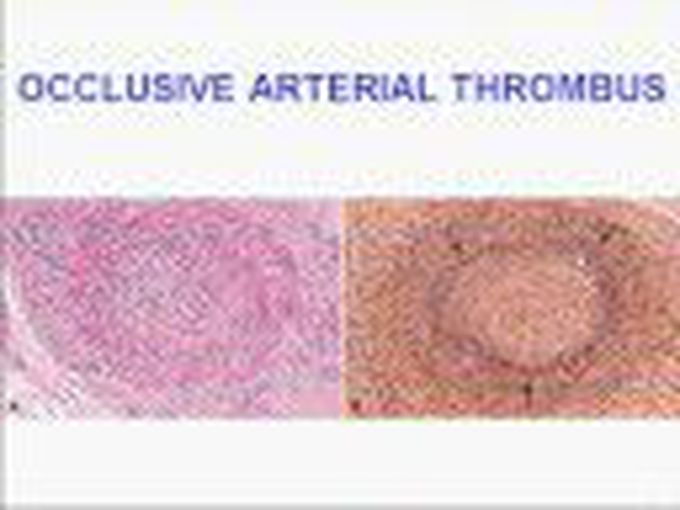 Chapter 4h: Hemodynamic Disorders, Thromboembolic Disease, and Shock (THROMOBOSIS) (DIC)