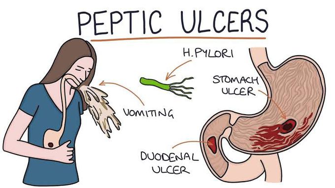 Peptic ulcers symptoms