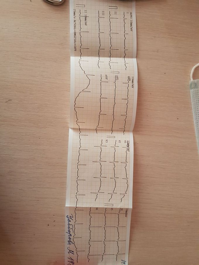 ECG , about cardiac pathology