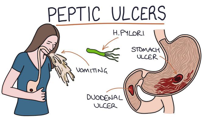 Learning about Peptic ulcers