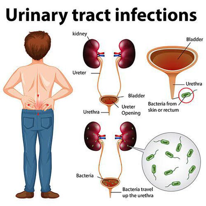 Treatment of UTIS