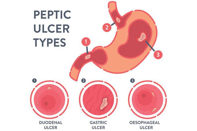 Gastric Ulcer Medizzy 