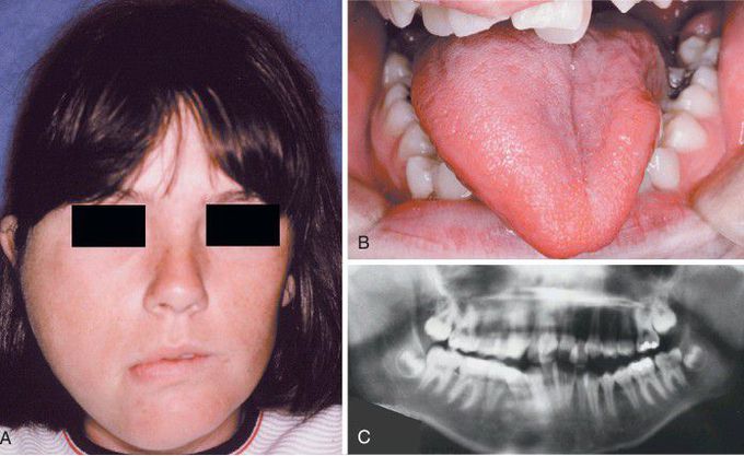 Hemihyperplasia case