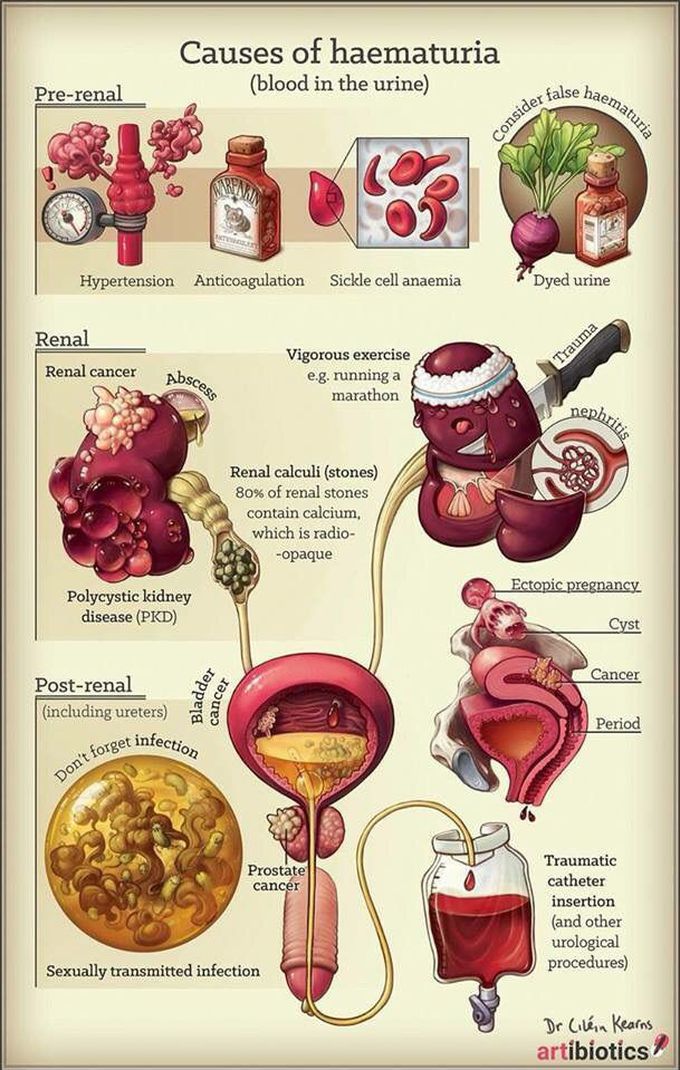 Causes of haematuria