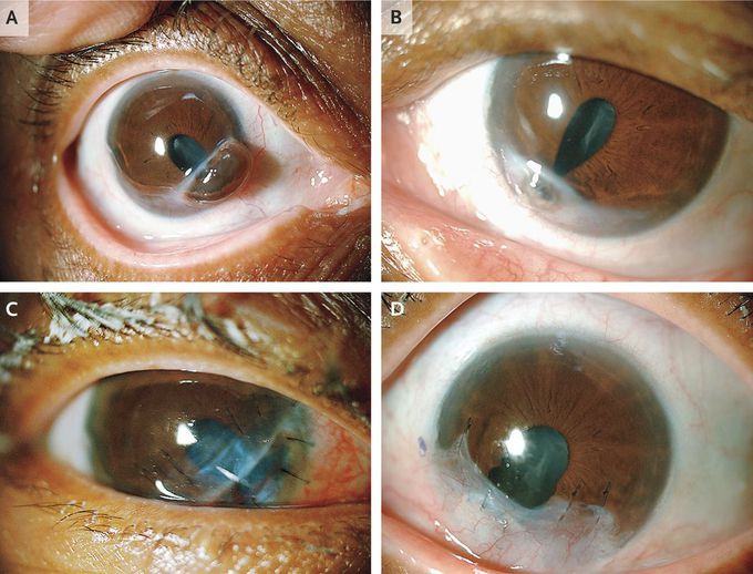 Bilateral Corneal Perforation