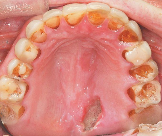 Bulimia Nervosa