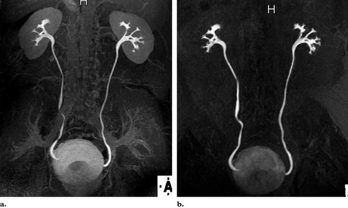 Comparison of different sequences and flip angles used for excretory MR urography