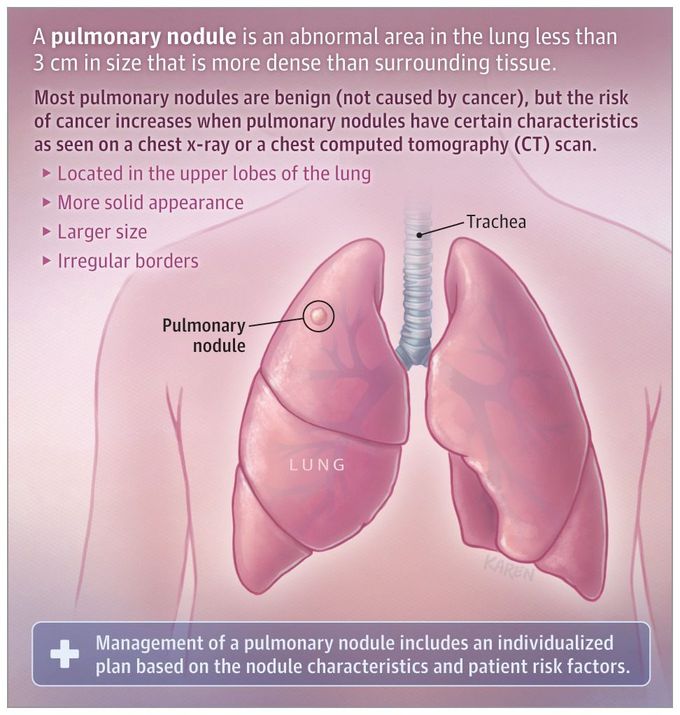 Pulmonary nodule