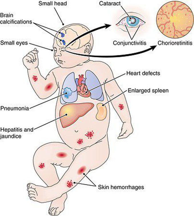 ToRCHeS Infections