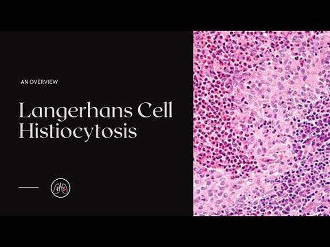 Precise pathology of Langerhans Cell Histiocytosis