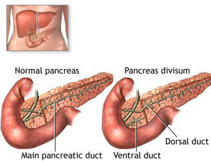 Pancreatic divisum