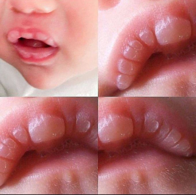 Sucction Pads in Baby's lips