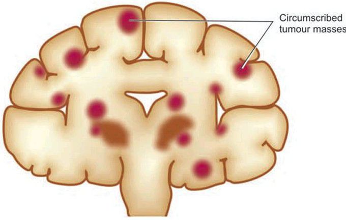 Metastatic tumour