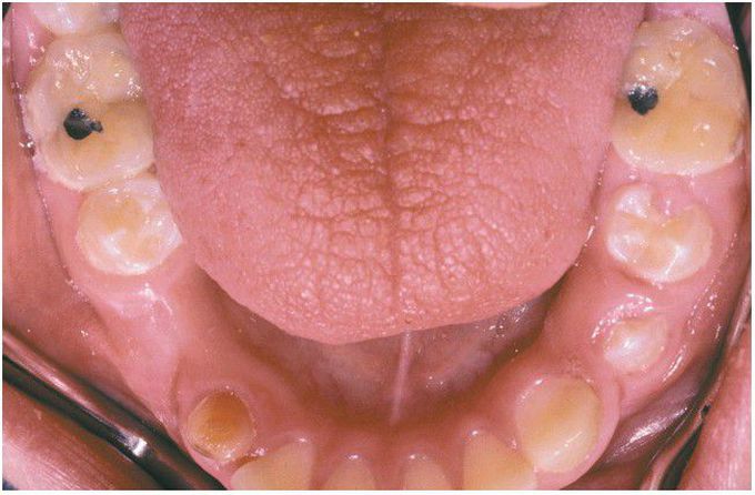 Salivary Gland Aplasia