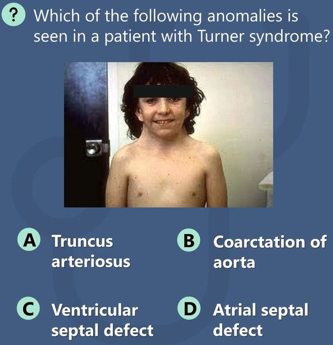 Turner Syndrome