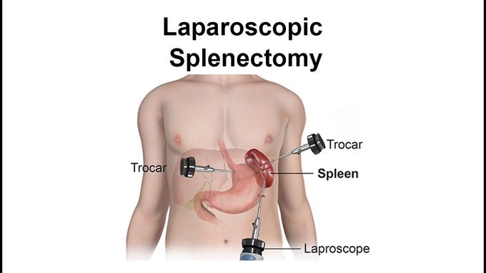 Laparoscopic splenectomy