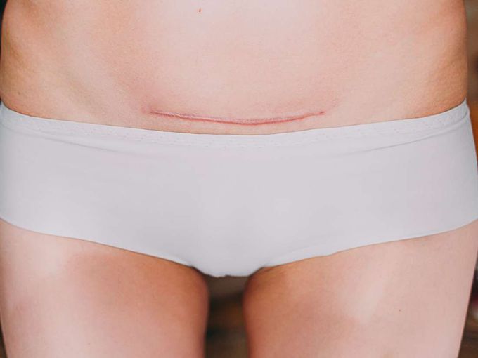 Long-term risks and benefits of C-section revealed