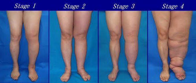 Stages of lymphoedema.