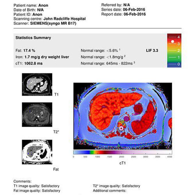 Multiparametric MRI, like LiverMultiScan