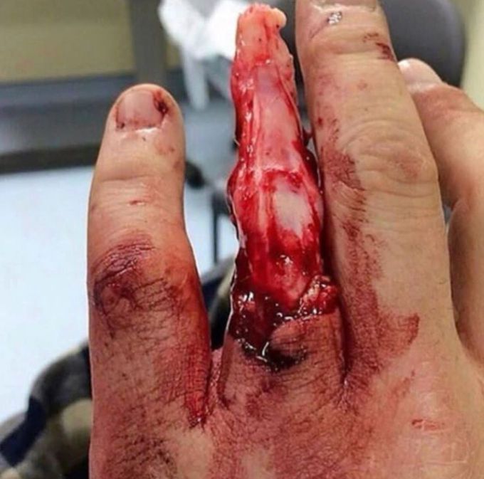 Severe Degloving Injury
